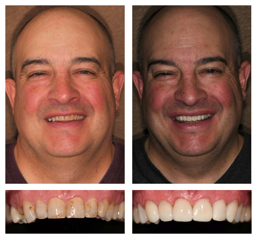 Dental transformation using dental veneers on a patient showing both before and after pictures.